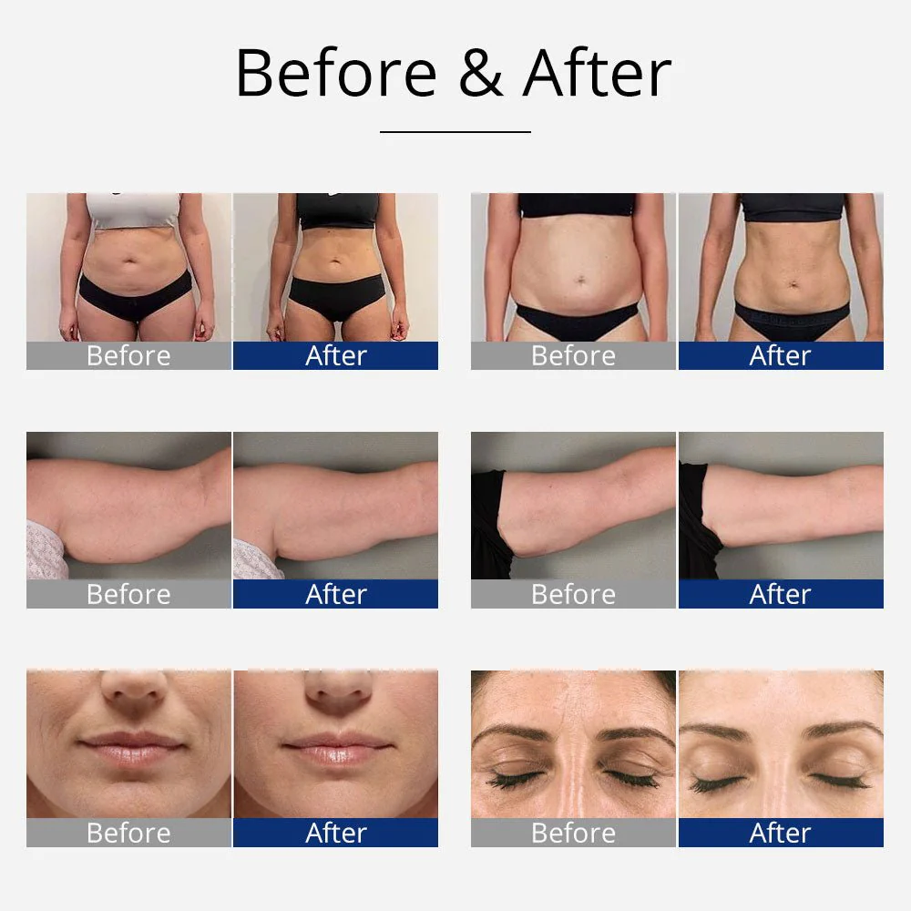Shape Tactics 4-in-1 Body Slimming with Unoisetion Cavitation, RF, and EMS - Image 11