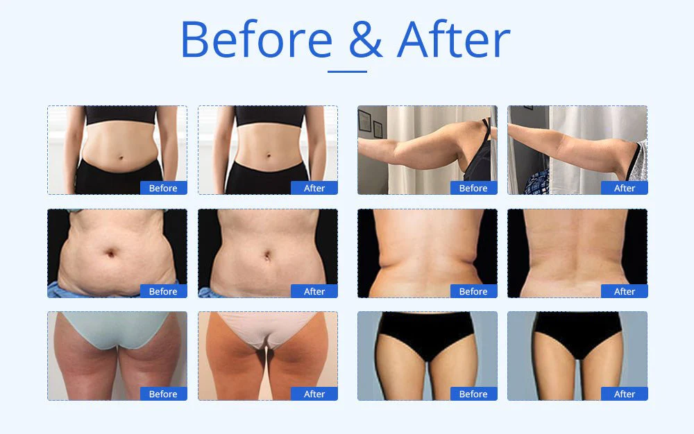 Shape Tactics 6-in-1 Advanced Unoisetion Cavitation 2.0 Vacuum RF Body Sculpting - Image 18