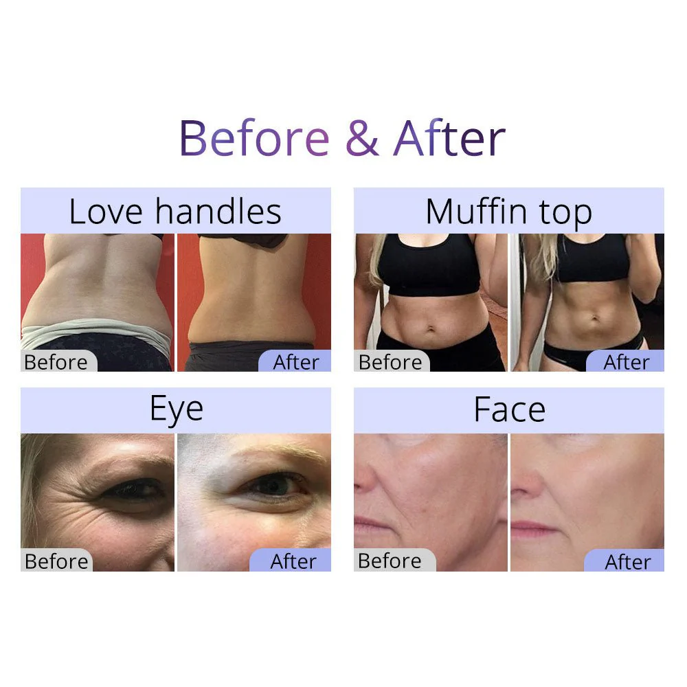 Shape Tactics 8-in-1 RF Cavitation Sculpt System - Image 8