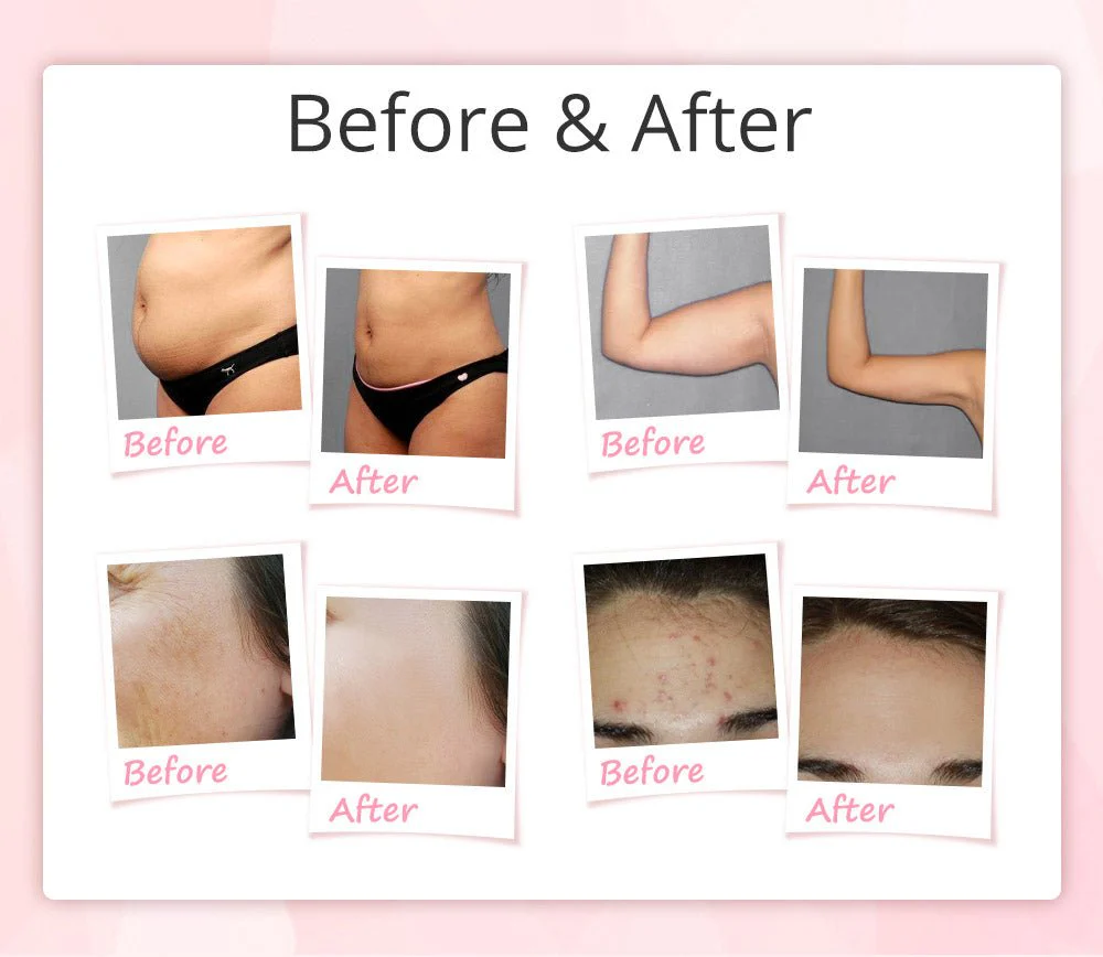 Shape Tactics - 9-in-1 Uniosetion Cavitation RF Vacuum Bio Photon Lipo Machine - Image 16
