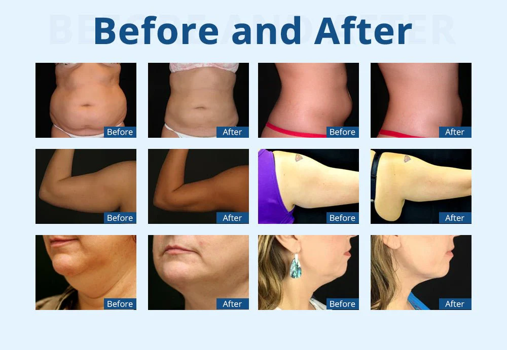 Shape Tactics - Advanced 3-Handle Cryolipolysis Fat Sculpting - Image 16