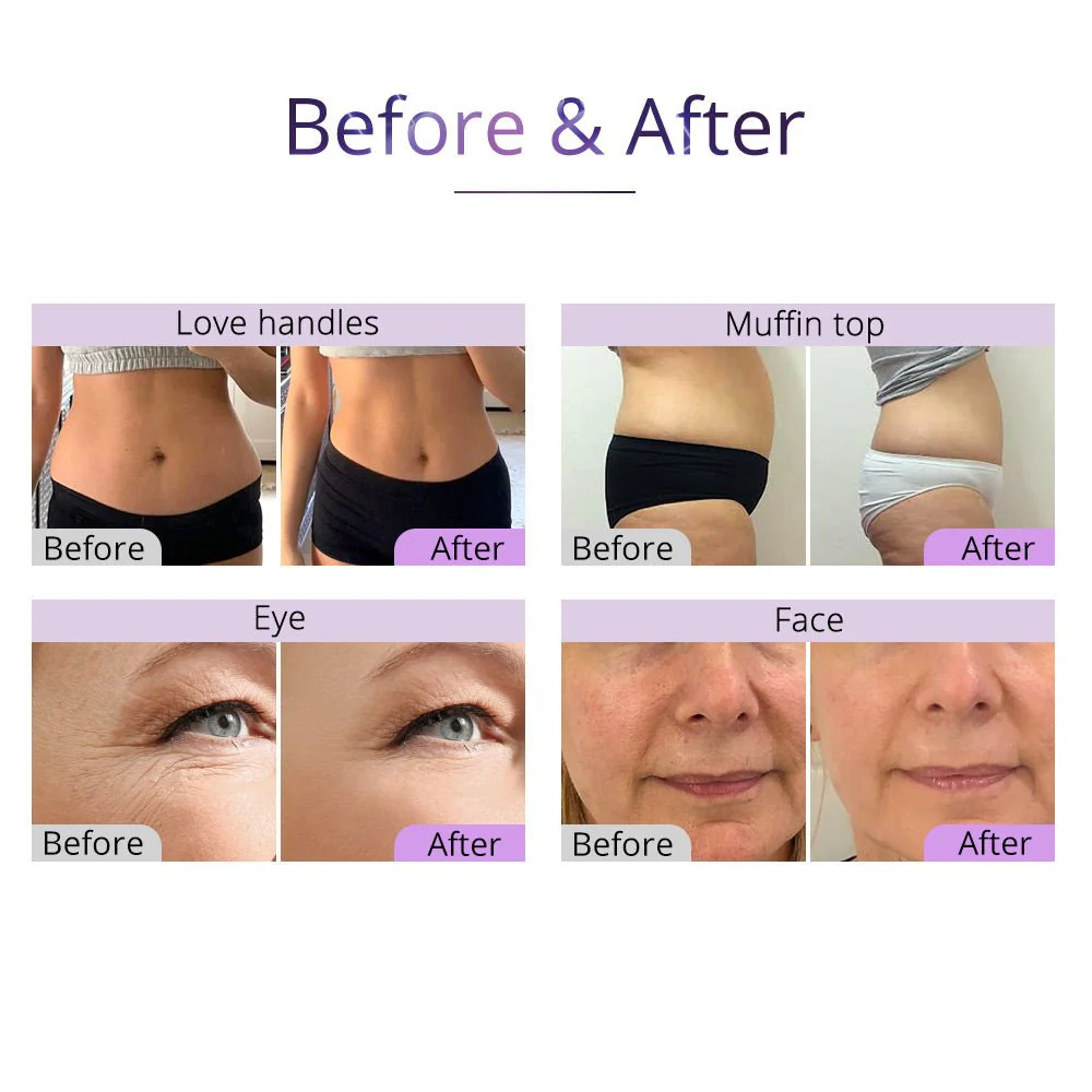 Shape Tactics Advanced 5-in-1 2.5 40K Cavitation Vacuum RF Technology - Image 13