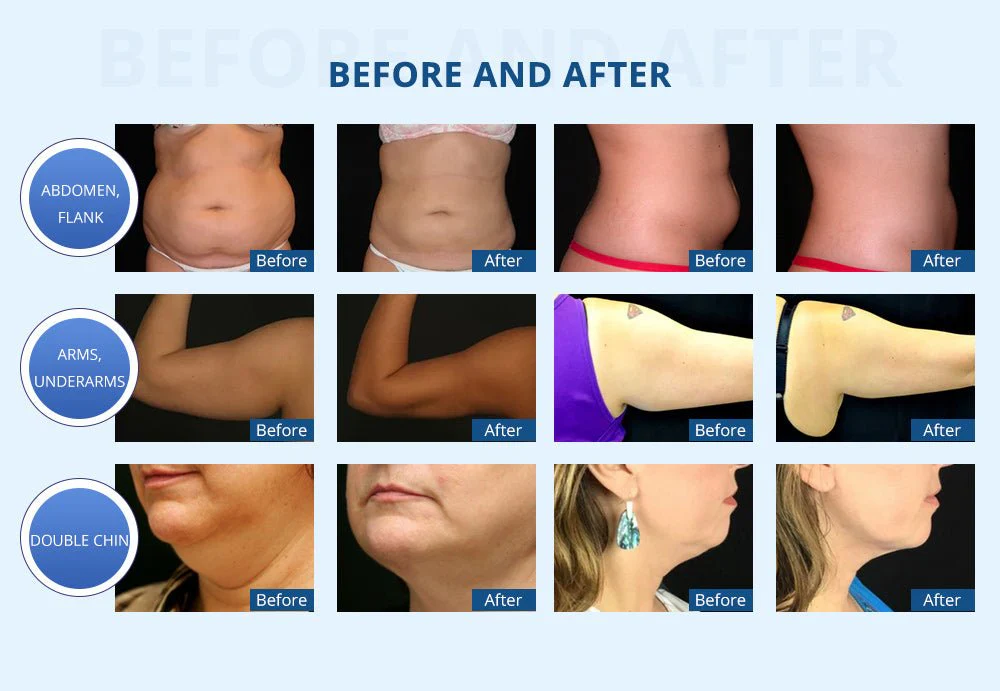 Shape Tactics Cryolipolysis Vacuum Slimming & Double Chin Removal Machine - Image 13