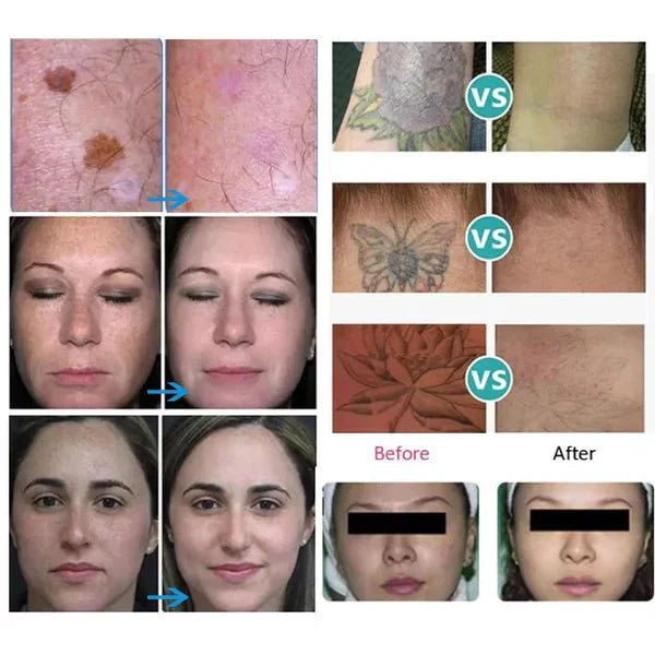 Shape Tactics - Precision Picosecond Laser: Tattoo Removal & Skin Renewal - Image 9